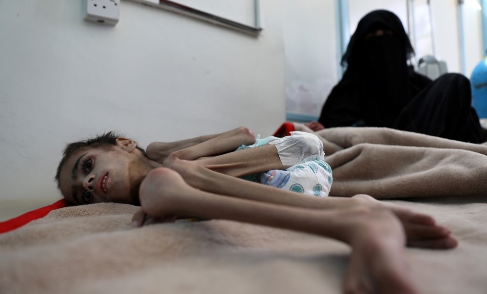 Yemenli çocuklar açlıkla boğuşuyor: 7 kiloya kadar düşen Faid Samim hayatta kalma mücadelesi veriyor