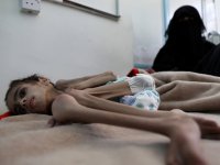 Yemenli çocuklar açlıkla boğuşuyor: 7 kiloya kadar düşen Faid Samim hayatta kalma mücadelesi veriyor